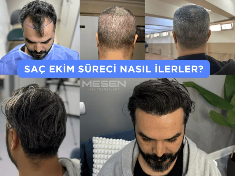saç ekim süreci nasıl olur?
