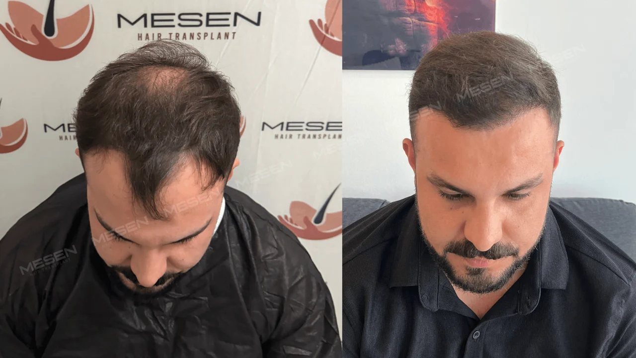 Üstten iki görünüm: solda tepe ve ön bölgede seyrek saçlar, sağda kısa saçlarla belirginleşen ön çizgi.