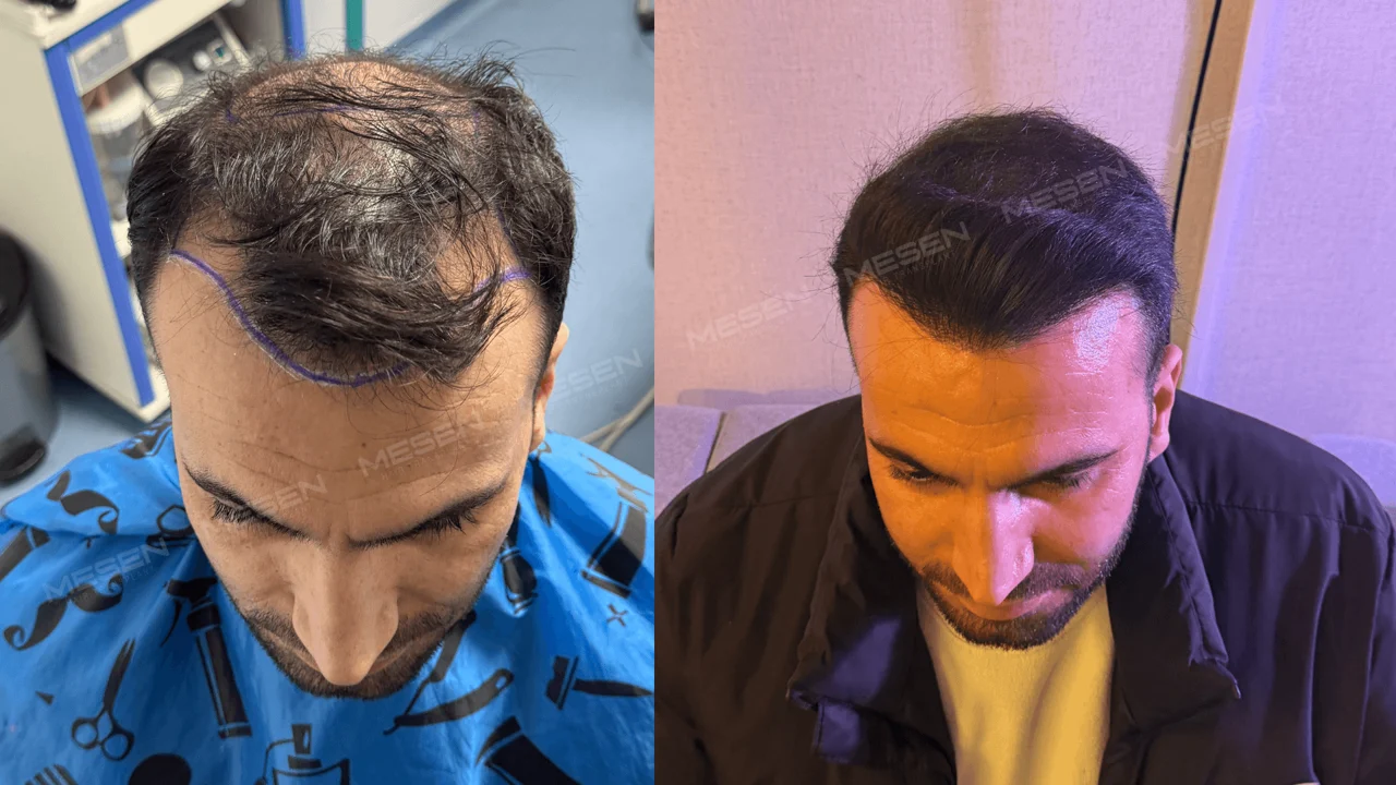 Solda mor çizgiyle işaretli ön sınır ve seyrek tepe, sağda farklı ışık altında kısa ön saç çizgisi.