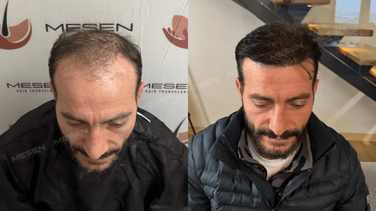 Başın öne eğildiği iki çekim; solda geniş alın ve seyrek üst saçlar, sağda yana taranmış koyu saçlar.