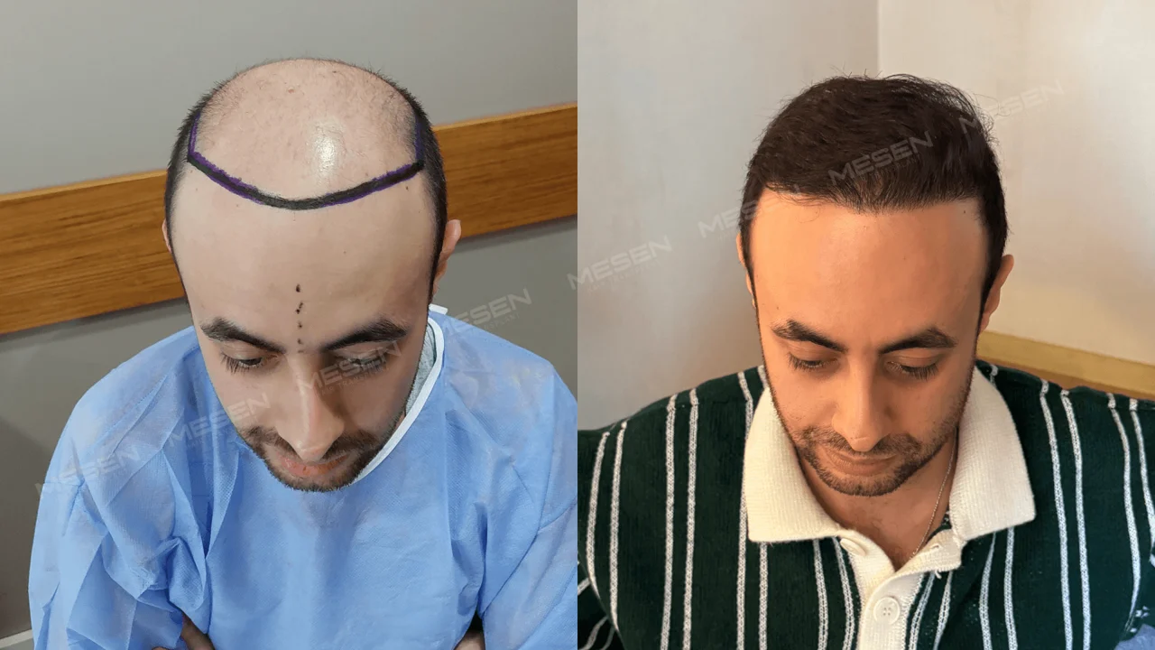 Solda kısaltılmış baş üzerinde mor ön çizgi, sağda çizgili gömlekli kişinin kısa saçlarla önden görünümü.