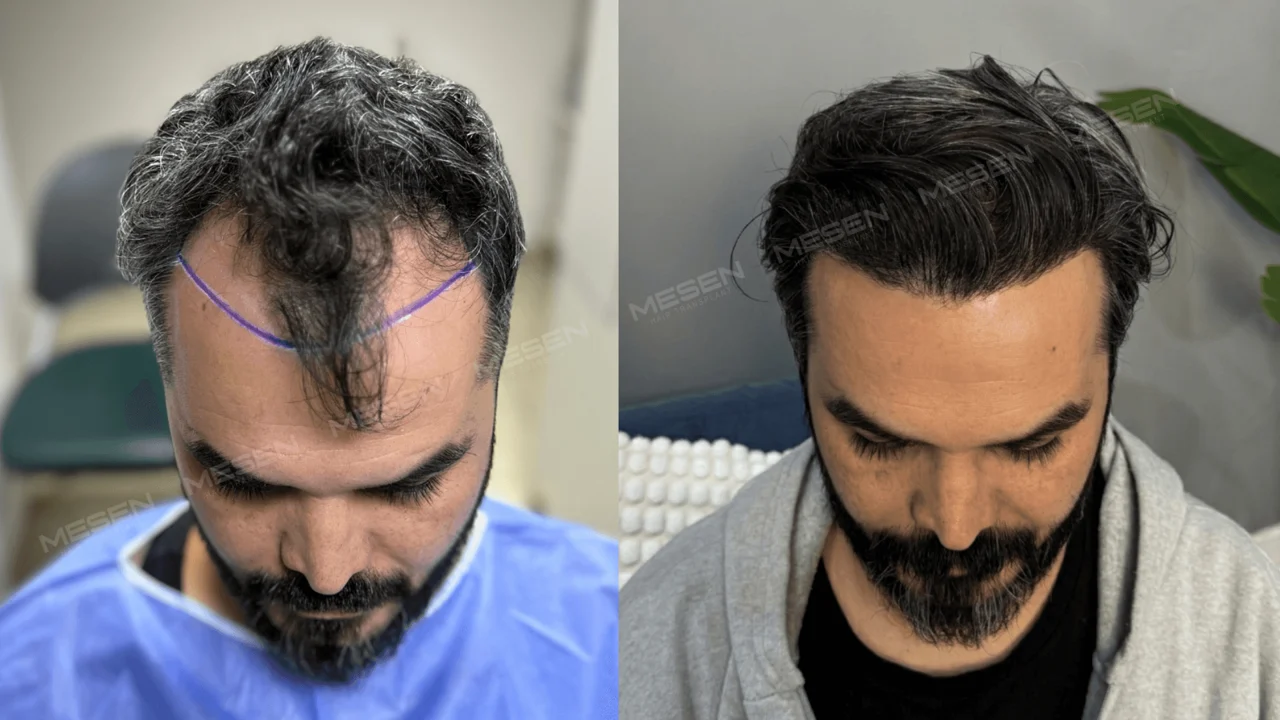 Solda ortada kalan uzun saç tutamı ve işaretli şakaklar, sağda geriye taranmış dalgalı ön saçlar.