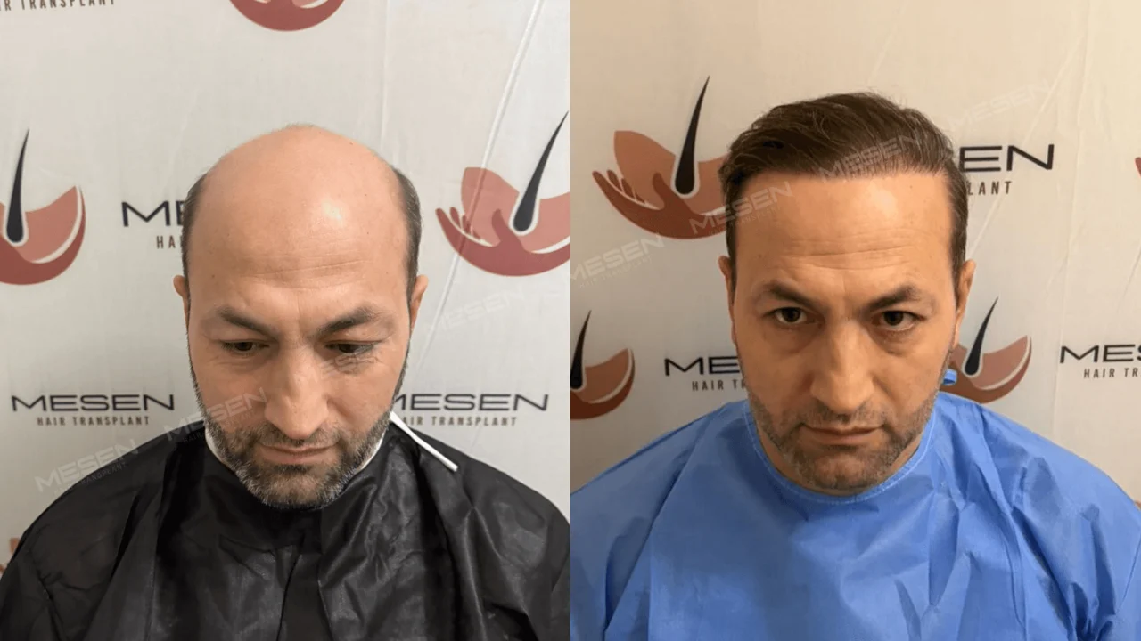Önden iki fotoğraf; solda üst kısmı geniş ölçüde açık baş, sağda yana doğru taranmış kısa ön saçlar.