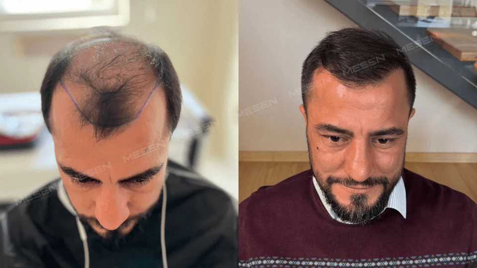 Solda geniş alın açıklığı, ortada saç tutamı ve çizilmiş sınır; sağda kısa saçlarla şakak ve ön bölge görünümü.