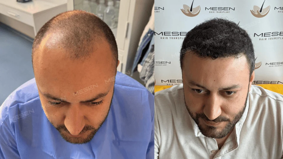 Başın üstten öne doğru görünümü: solda çok kısa ve seyrek ön saçlar, sağda kısa kıvırcık saçlarla çevrili alın.