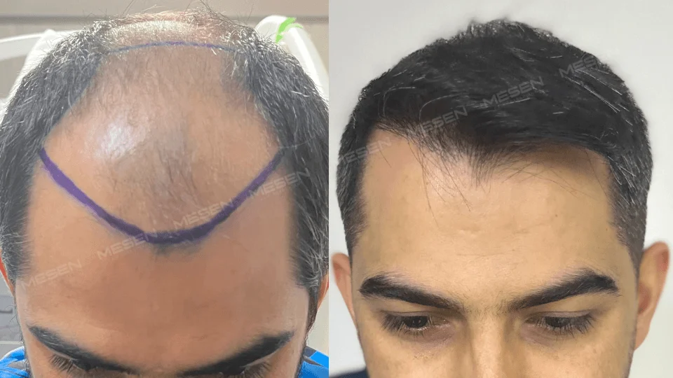 Solda ön bölgede geniş açıklığı çevreleyen mor çizgi, sağda kısa koyu saçlarla önden alın ve şakak görünümü.