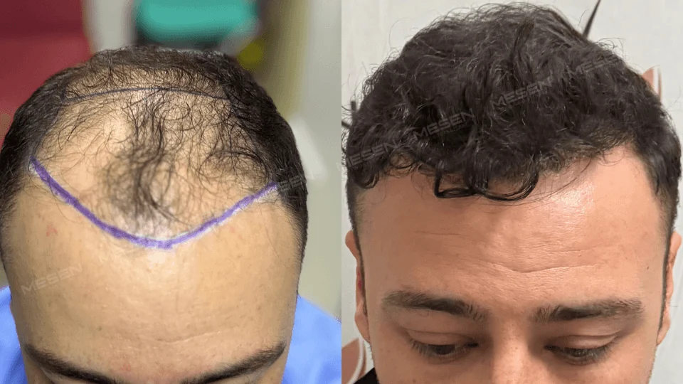 Solda mor sınırın gerisinde ince ve aralıklı ön saçlar, sağda alna yakın duran koyu kıvırcık saçlar.