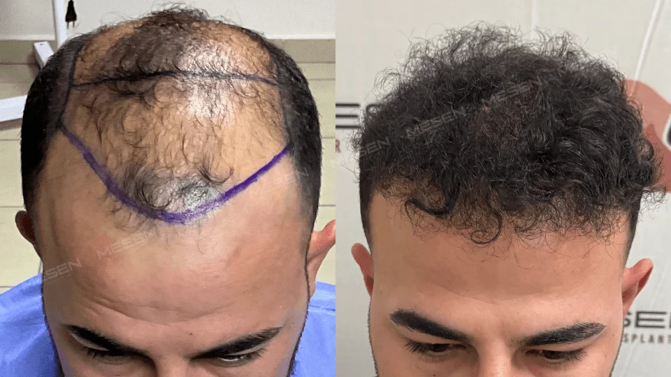 Solda mor çizgilerle bölümlenmiş seyrek üst saçlar, sağda kısa kıvırcık saçların öne doğru şekillendiği görünüm.
