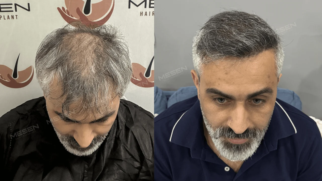 Kır saçların iki önden üst çekimi; solda orta bölümde belirgin saç derisi, sağda yana taranmış kısa üst saçlar.