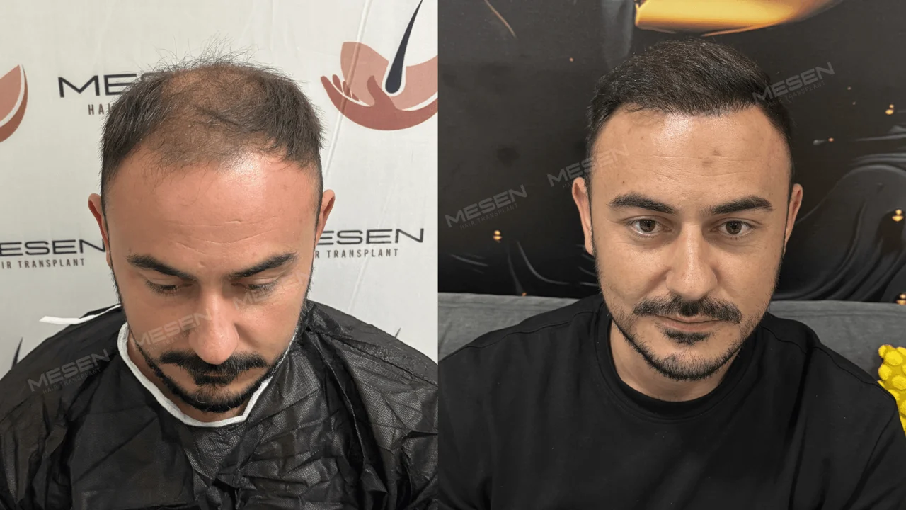 Solda alın ve tepe arasında seyrek kısa saçlar, sağda kısa kesilmiş saçlarla daha belirgin görünen ön sınır.