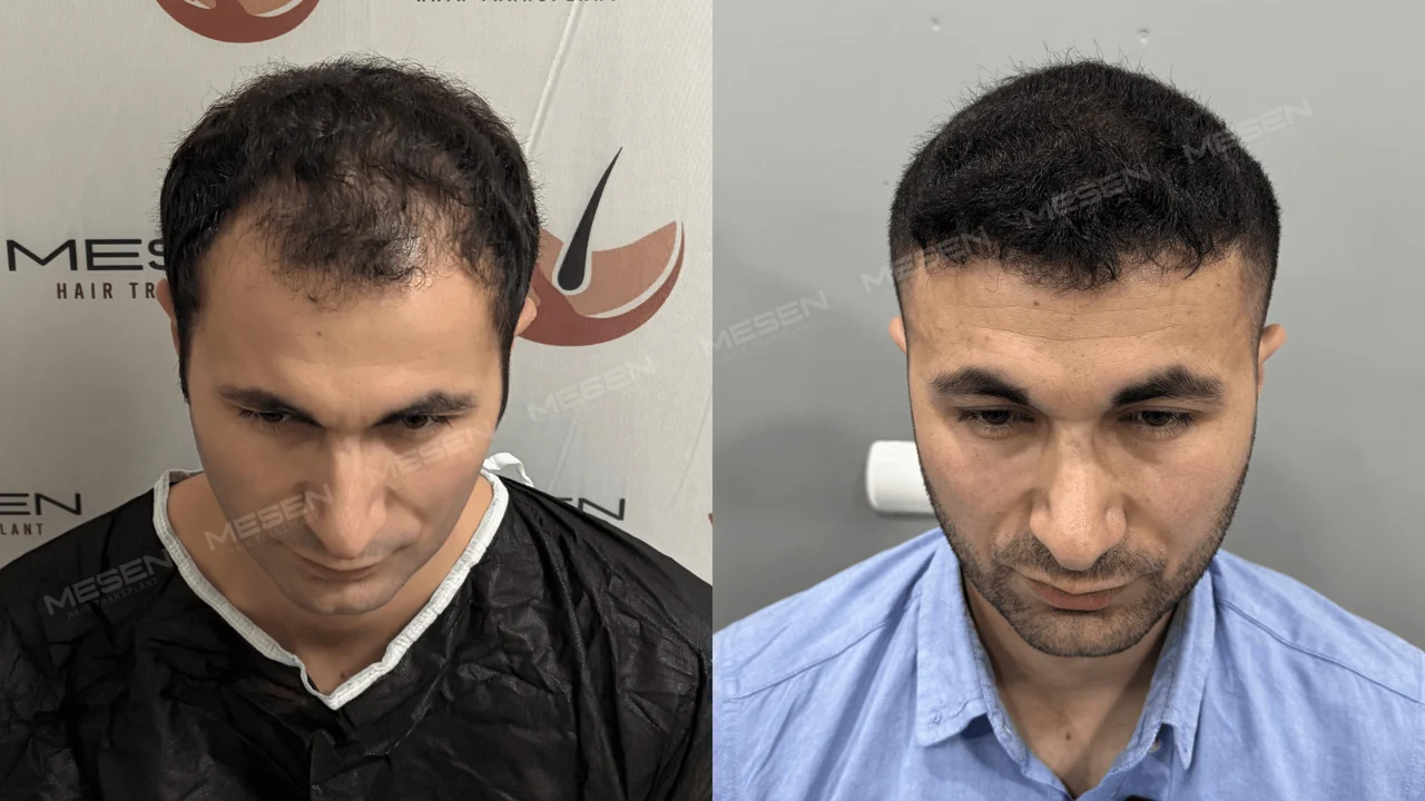 Önden iki görünüm; solda ön bölgede aralıklı kısa saçlar, sağda daha düzenli bir sınır oluşturan kısa saçlar.